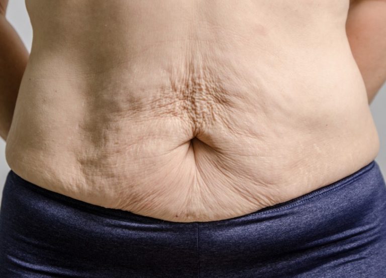 How To Get Rid Of Excess Skin After Weight Loss